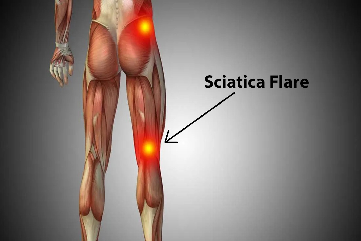 Causes of Sciatica Flare Up and What You Should Do?