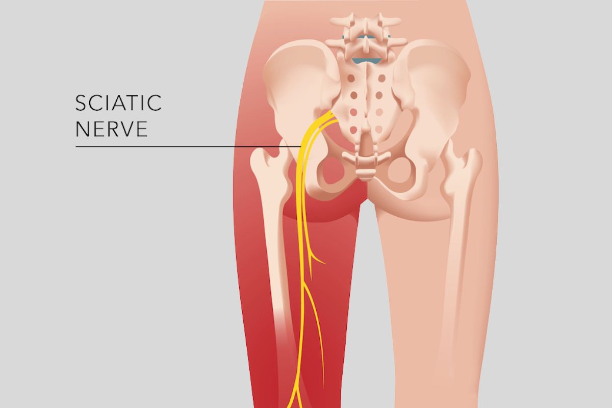 Other Effective Remedies for Sciatica Pain