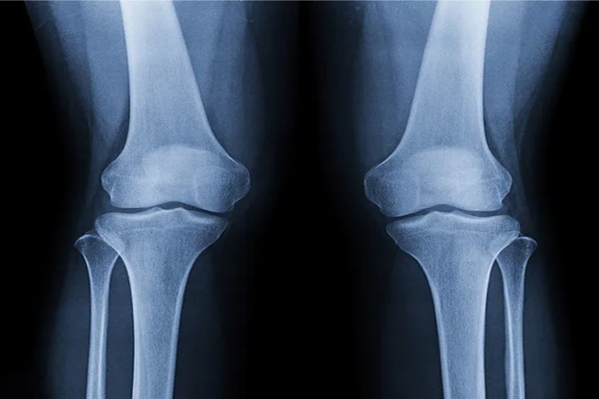 Diagnosing Bone-on-Bone Knee Pain